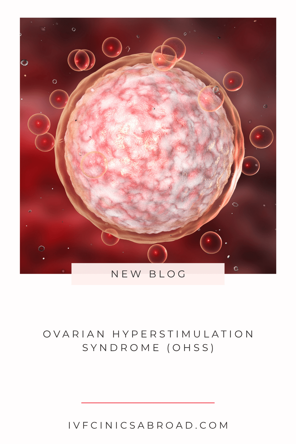 Syndrome d'hyperstimulation ovarienne (SHO)