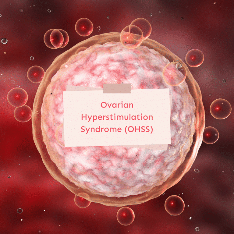 Ovarian Hyperstimulation Syndrome (OHSS)