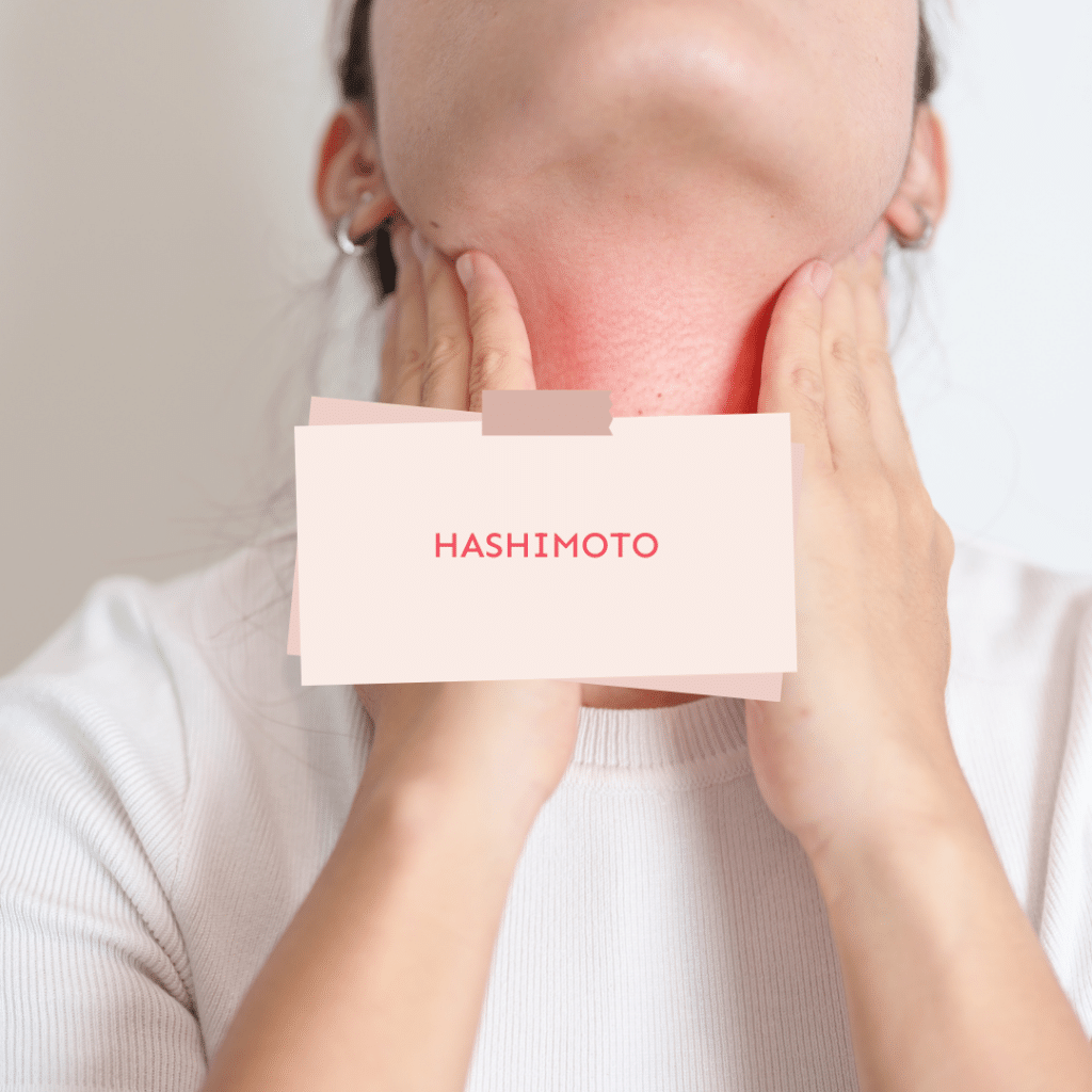 Trying to Conceive with Hypothyroidism / Hashimoto’s Thyroiditis: Causes, Diagnosis and Treatment 1 Hashimoto